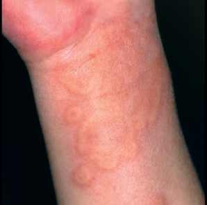 аллергия крапивница лечение у детей