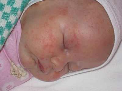 аллергия на картофель у ребенка фото