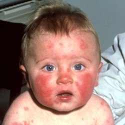 аллергия на курицу у ребенка фото