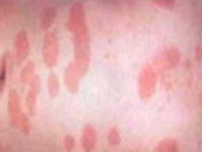 аллергия на персики у ребенка фото