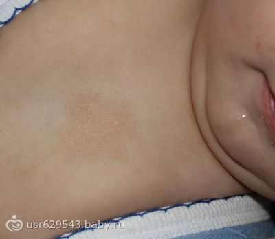 аллергия на персики у ребенка фото