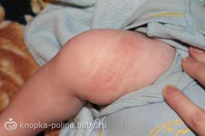 аллергия на щечках у ребенка 1 5 года