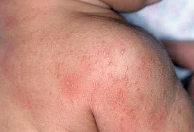 аллергия на щечках у ребенка 1 5 года
