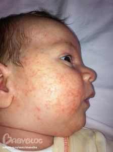 Аллергия на щечках у ребенка 3 года