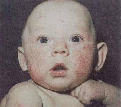аллергия на сладкое у детей фото