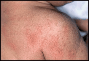 аллергия на сумамед у детей чем лечить