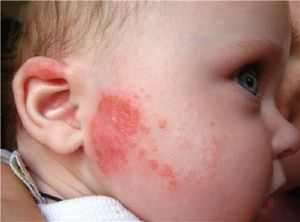 Аллергия от молока у детей фото
