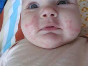 Аллергия у 3 месячного ребенка чем лечить