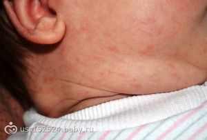 Аллергия у 8 месячного ребенка