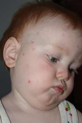 аллергия у детей до года комаровский видео