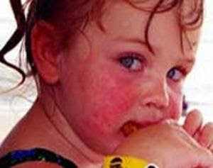 аллергия у ребенка 1 год фото