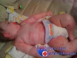Аллергия у ребенка 1 год фото