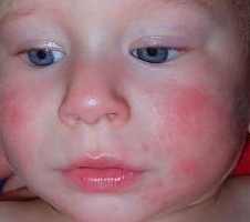 аллергия у ребенка 1 месяца как лечить