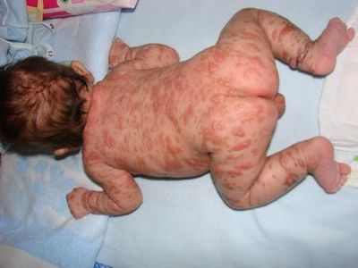 аллергия у ребенка крапивница
