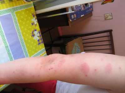 анализы на аллергию у детей