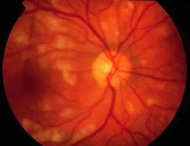 ангиопатия сетчатки глаза у ребенка лечение