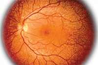 ангиопатия сетчатки глаза у ребенка лечение