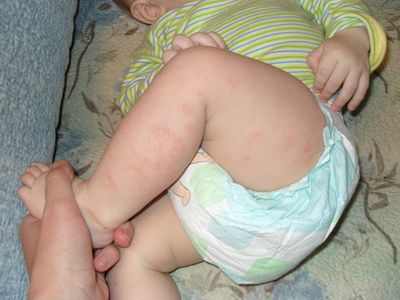 бронхит у ребенка 7 месяцев т чем лечить