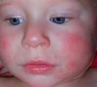 гайморит у ребенка 4 лет симптомы и лечение