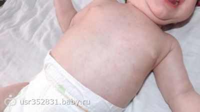 глисты у 10 месячного ребенка фото