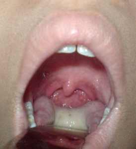 грибок горла у ребенка лечение