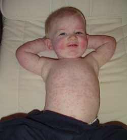 грибок на теле ребенка фото