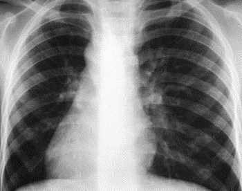 инфильтративный туберкулез легких у детей