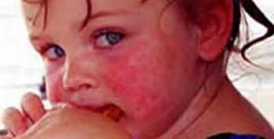 ячмень у грудного ребенка лечение комаровский