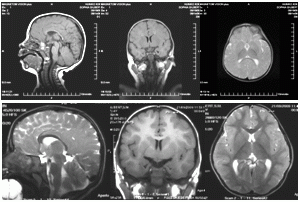 энцефалопатия головного мозга у детей до года
