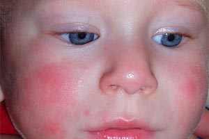 как снять аллергию у ребенка