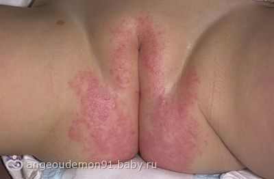 как выглядит аллергия у детей на теле