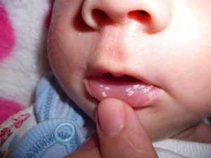 Кандидоз полости рта у детей комаровский