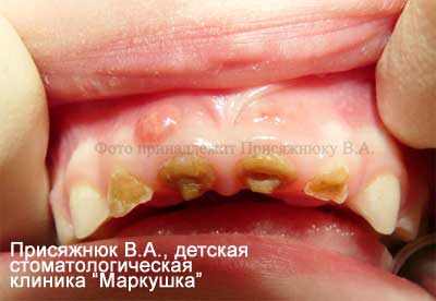 кариес зубов у детей 1 года