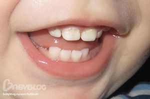 Кариес зубов у детей 1 года