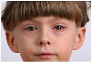 Красные глаза у ребенка чем лечить