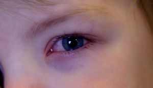 Красные глаза у ребенка причины и лечение