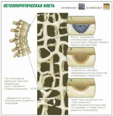 лечение остеопороза у детей в москве