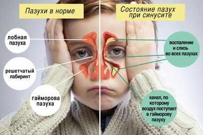 лечение синусита у детей форум