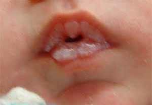 молочница во рту у детей до года