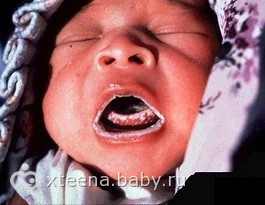 молочница во рту у ребенка 4 года