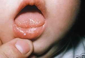 Молочница во рту у ребенка 4 года