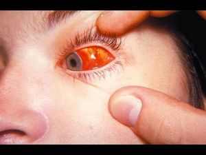 Мононуклеоз у детей симптомы и лечение комаровский