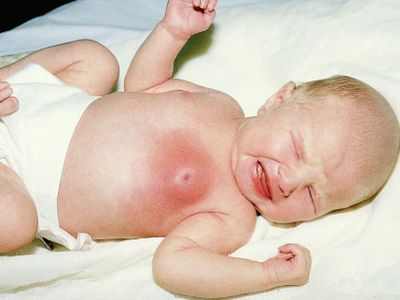 операция водянка яичка у ребенка 2 лет