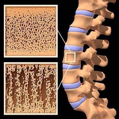 остеопороз пяточной кости у детей