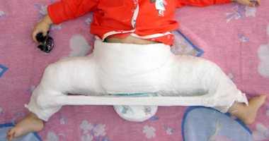 перелом шейки бедра у детей лечение