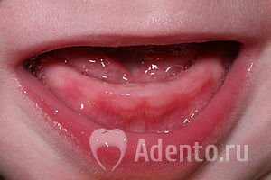 Понос у 11 месячного ребенка на зубы