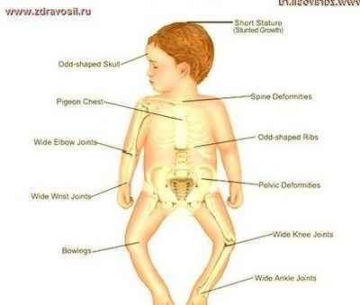признаки гидроцефалии у детей до года
