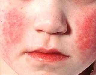 признаки менингита у маленьких детей до года