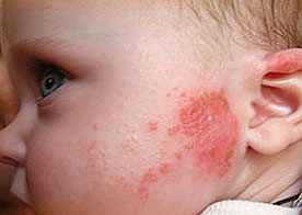 профилактика аллергии у детей