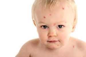 Проходит ли аллергия у детей